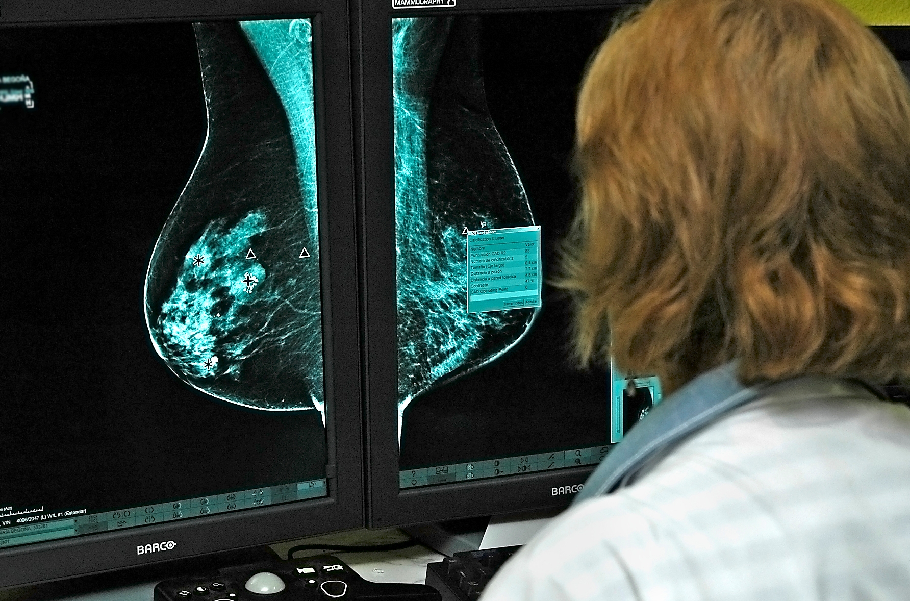 El Hospital General Universitario de Ciudad Real abre una nueva línea de investigación sobre el cáncer de mama