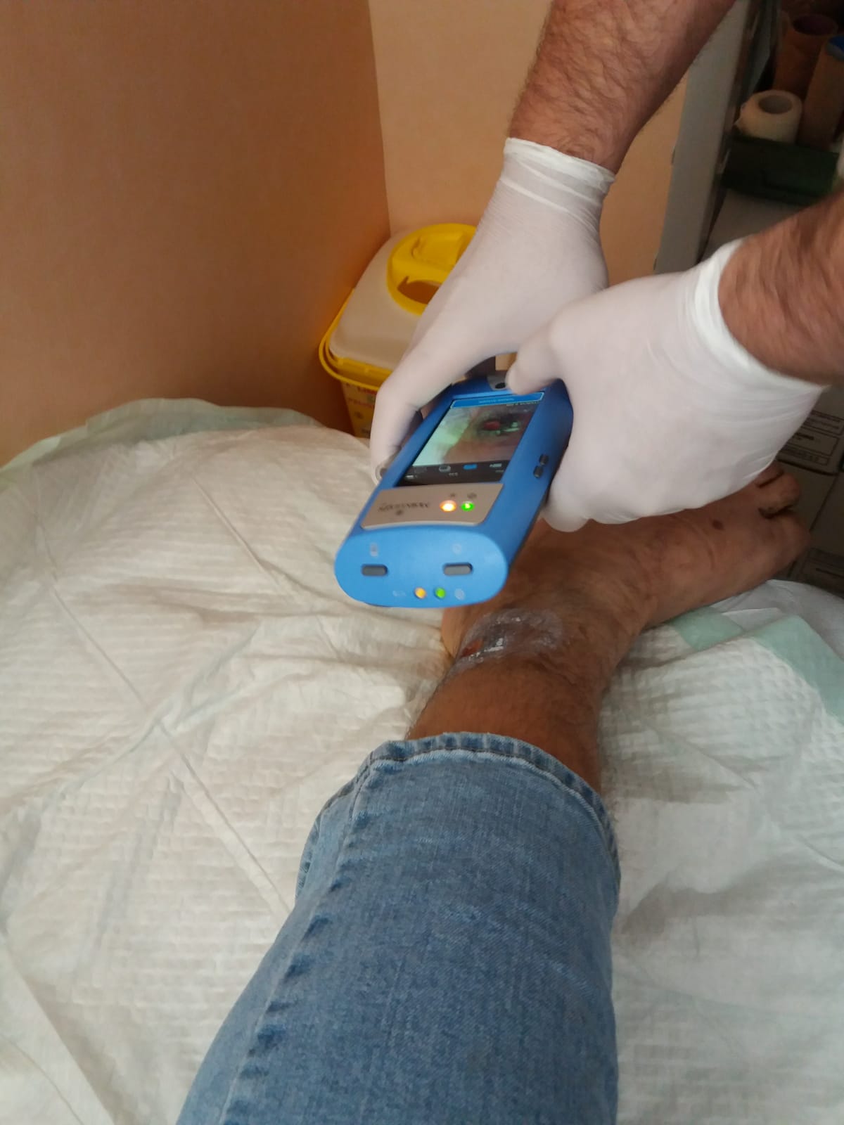  El hospital Santa Lucía pone en marcha un sistema innovador para detectar de manera precoz las infecciones en heridas crónicas 