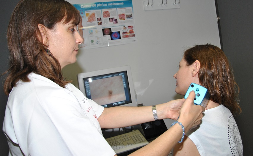 El Hospital de la Plana avanza en la detección de los tumores cutáneos a través del dermatoscopio digital
